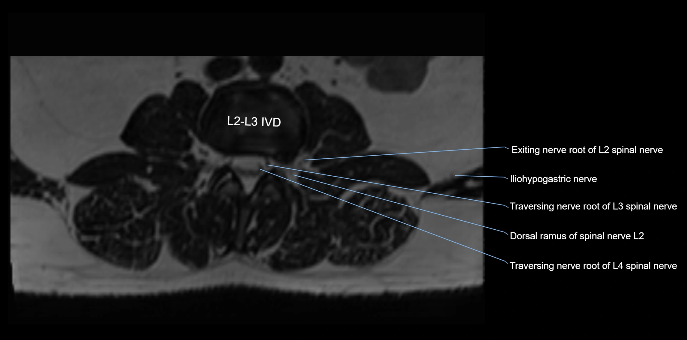 MR lumbosacral plexus axial cross sectional anatomy 3T  radiology  image-img-1008001-00013.webp